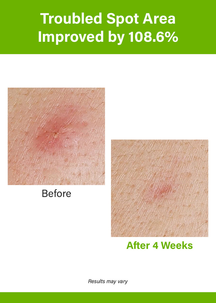 Anua Azelaic Acid 10 Hyaluron Redness Soothing Serum 30ml Seoul Scandal - Shop Miss A