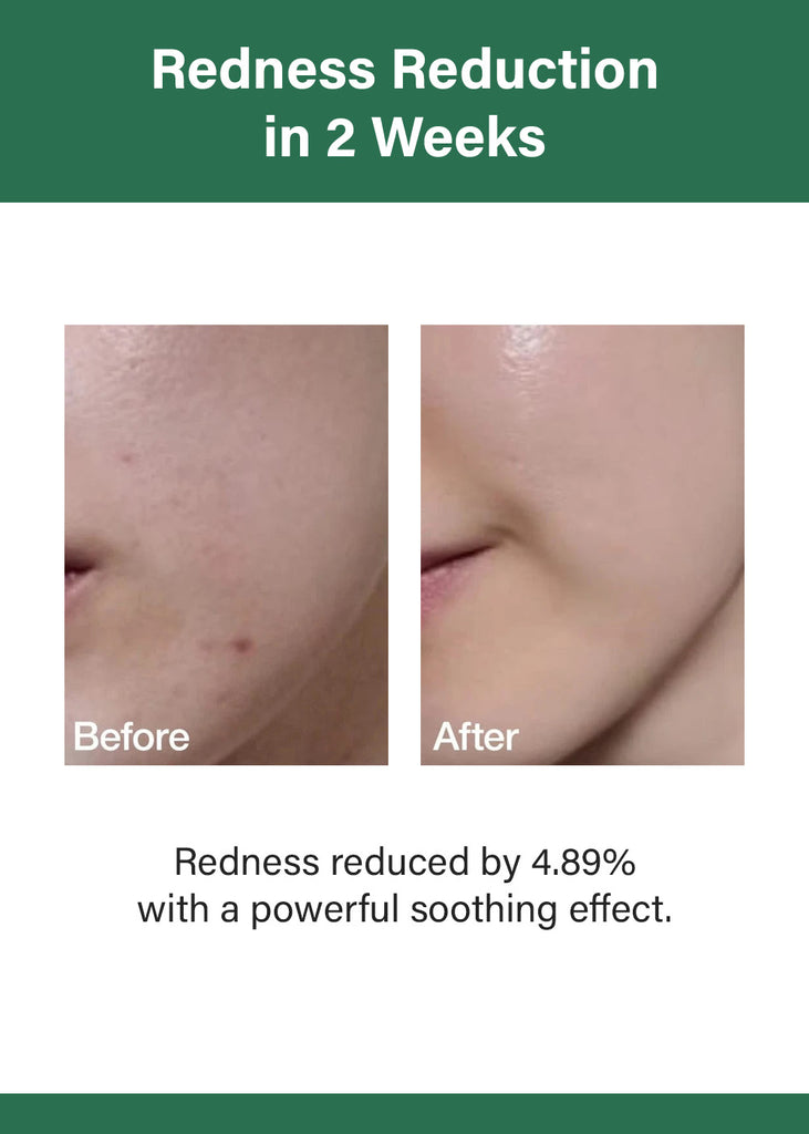 Anua Heartleaf 80 Moisture Soothing Ampoule 30ml Seoul Scandal - Shop Miss A